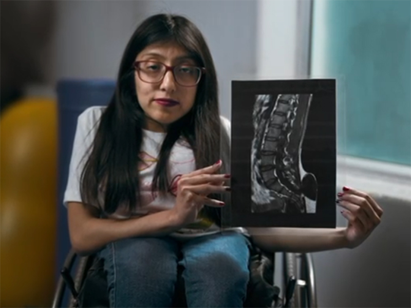 La espina bífida es un defecto congénito que causa discapacidad severa.